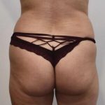 Brazilian Buttock Augmentation Before & After Patient #1531