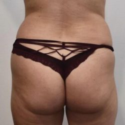 Brazilian Buttock Augmentation Before & After Patient #1531