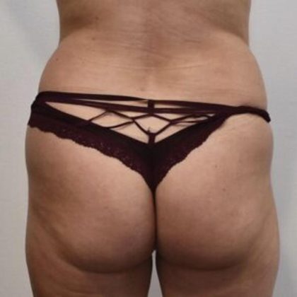 Brazilian Buttock Augmentation Before & After Patient #1531