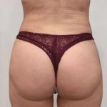 Brazilian Buttock Augmentation Before & After Patient #1531