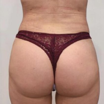 Brazilian Buttock Augmentation Before & After Patient #1531