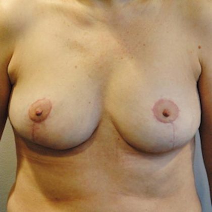 Breast Implant Removal Before & After Patient #1546