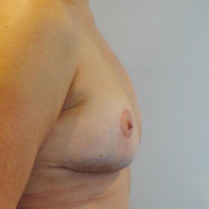 Breast Implant Removal Before & After Patient #1546