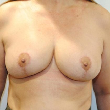 Breast Implant Removal Before & After Patient #1548
