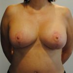 Breast Lift & Augmentation Before & After Patient #1549