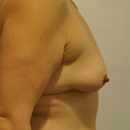 Breast Lift & Augmentation Before & After Patient #1549