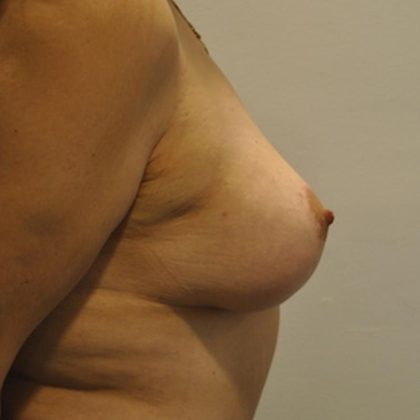 Breast Lift & Augmentation Before & After Patient #1549