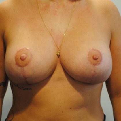 Breast Lift & Augmentation Before & After Patient #1555