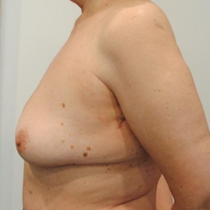 Breast Lift & Augmentation Before & After Patient #1556