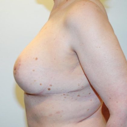 Breast Lift & Augmentation Before & After Patient #1556