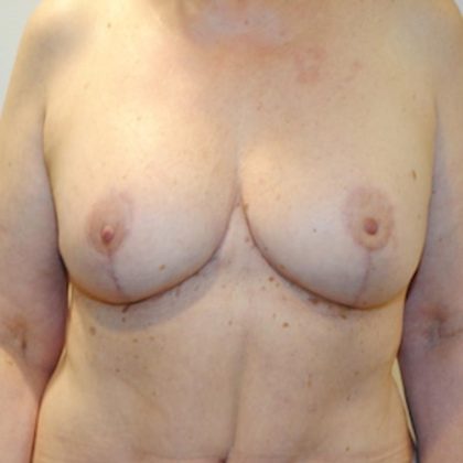 Breast Lift & Augmentation Before & After Patient #1556