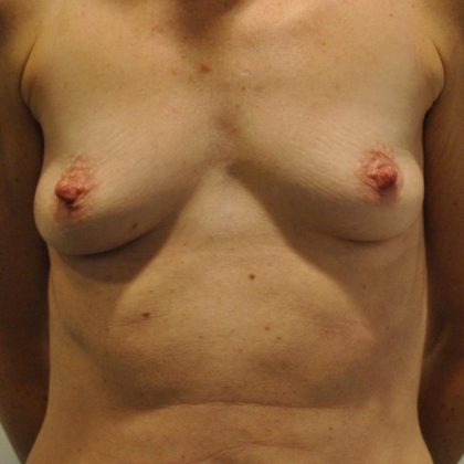 Breast Augmentation Before & After Patient #404