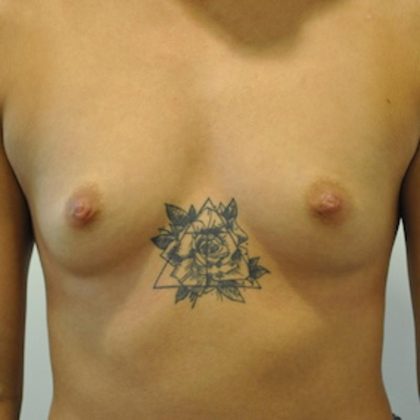 Breast Augmentation Before & After Patient #405
