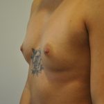 Breast Augmentation Before & After Patient #405