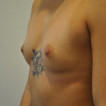 Breast Augmentation Before & After Patient #405