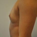 Breast Augmentation Before & After Patient #405