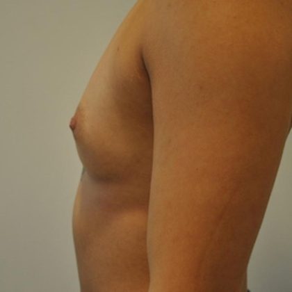 Breast Augmentation Before & After Patient #405