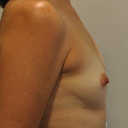 Breast Augmentation Before & After Patient #837
