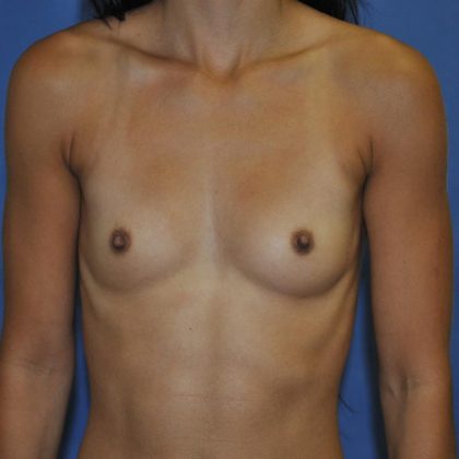 Breast Augmentation Before & After Patient #841