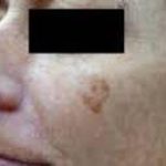 Brown Spot Before & After Patient #876