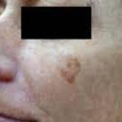 Brown Spot Before & After Patient #876