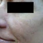 Brown Spot Before & After Patient #876