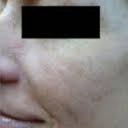 Brown Spot Before & After Patient #876