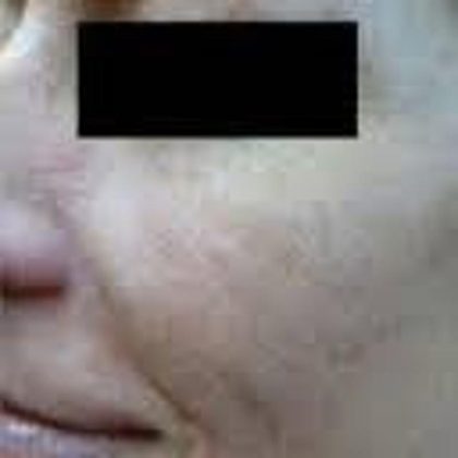 Brown Spot Before & After Patient #876