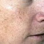 Brown Spot Before & After Patient #877