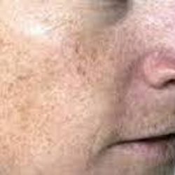 Brown Spot Before & After Patient #877