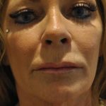 Chemical Peels Before & After Patient #1652