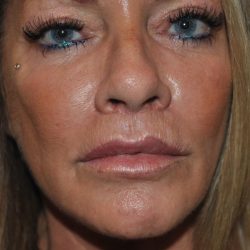 Chemical Peels Before & After Patient #1652