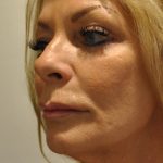 Chemical Peels Before & After Patient #1652