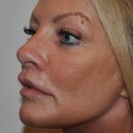Chemical Peels Before & After Patient #1652