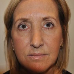 Chemical Peels Before & After Patient #900