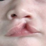 Cleft lip and palate Before & After Patient #1578
