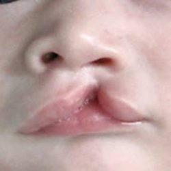 Cleft lip and palate Before & After Patient #1578
