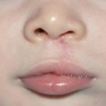 Cleft lip and palate Before & After Patient #1578