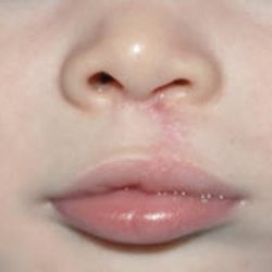 Cleft lip and palate Before & After Patient #1578