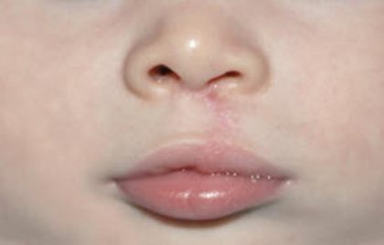 Cleft lip and palate Before & After Patient #1578