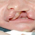 Cleft lip and palate Before & After Patient #1560