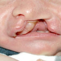 Cleft lip and palate Before & After Patient #1560