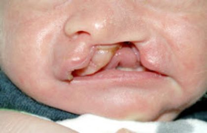 Cleft lip and palate Before & After Patient #1560