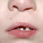 Cleft lip and palate Before & After Patient #1560
