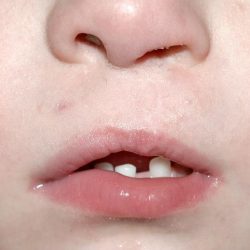 Cleft lip and palate Before & After Patient #1560