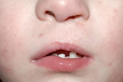 Cleft lip and palate Before & After Patient #1560