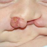 Cleft lip and palate Before & After Patient #1570