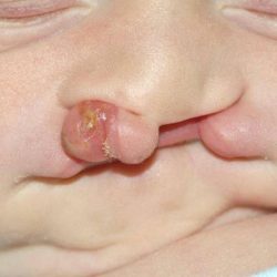 Cleft lip and palate Before & After Patient #1570