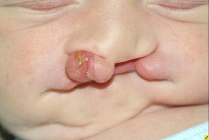 Cleft lip and palate Before & After Patient #1570