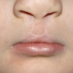Cleft lip and palate Before & After Patient #1570